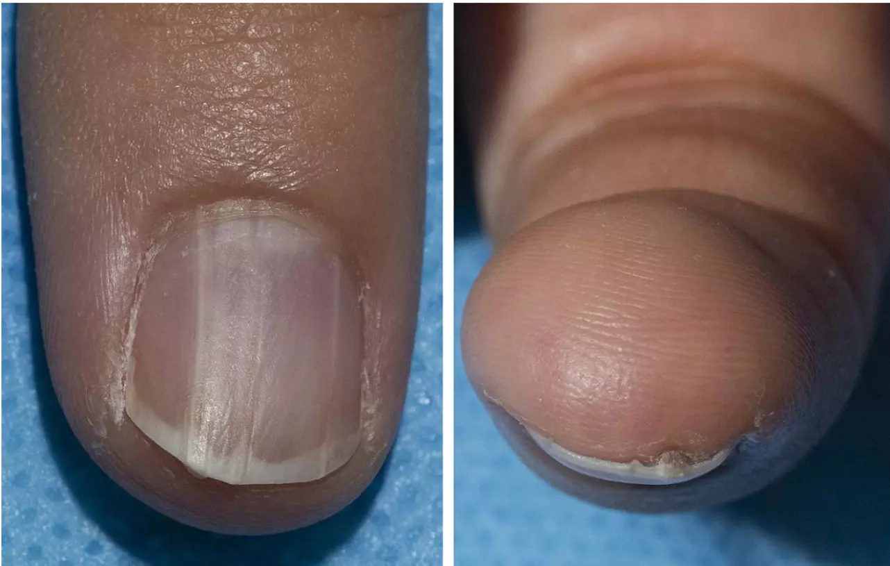 How your nail colour can signal cancer risk