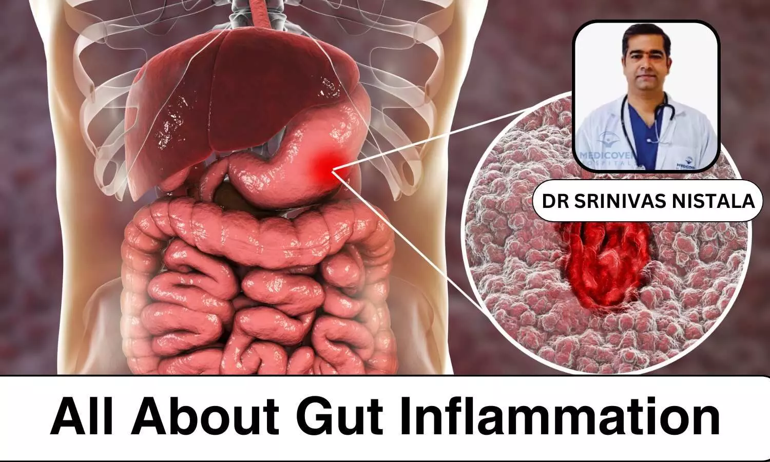 The Lowdown on Gut Inflammation: Causes, Symptoms, and Diagnosis and Treatment - Dr Srinivas Nistala