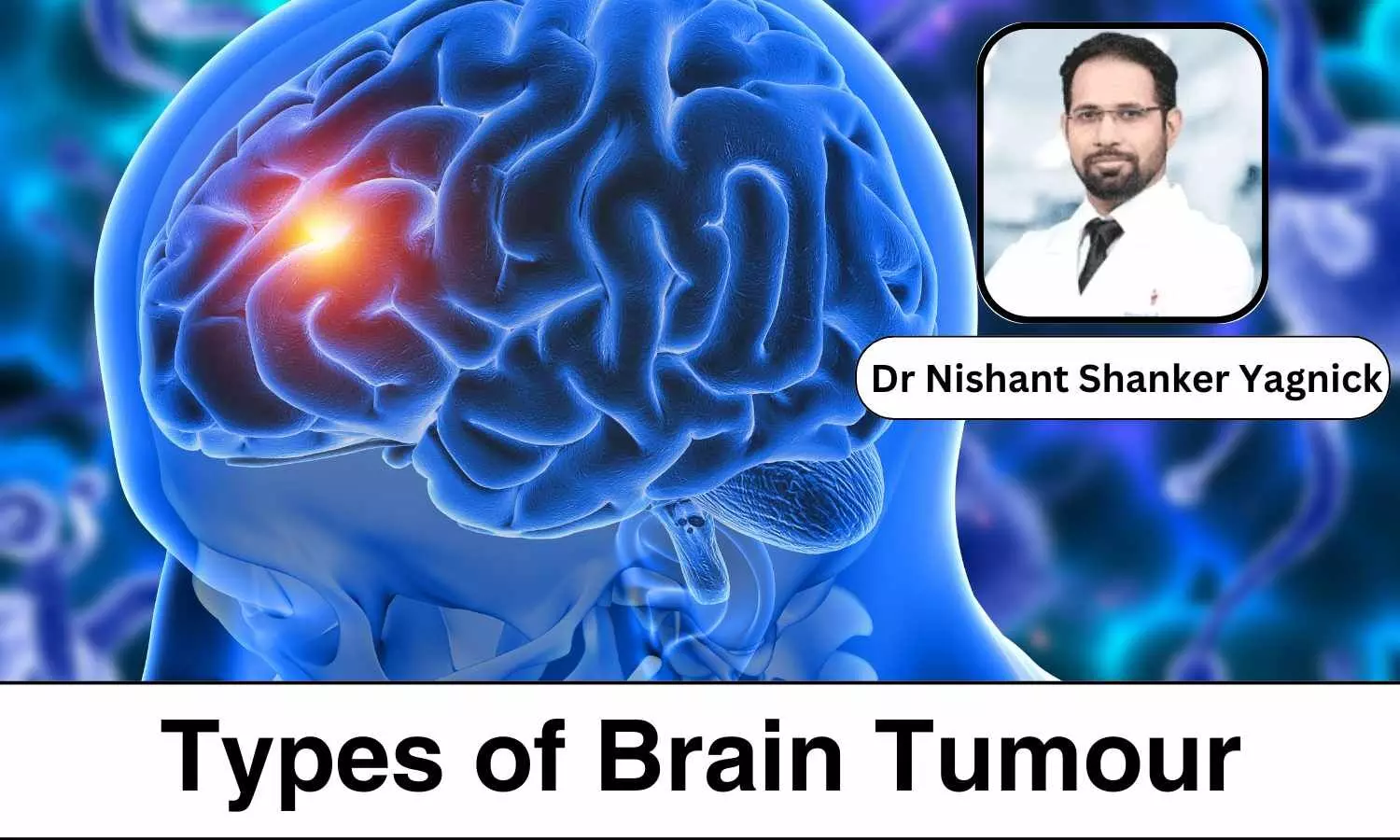 World Brain Tumour Day 2024: What are the different types of Brain Tumour? - Dr Nishant Shanker Yagnick