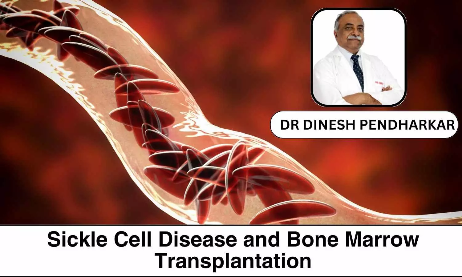 World Sickle Cell Day 2024: Sickle Cell Disease and Bone Marrow Transplantation - Dr Dinesh Pendharkar