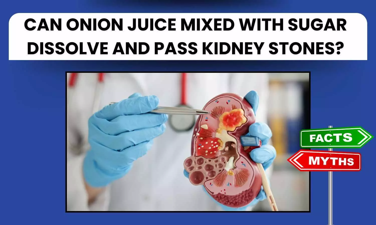 Can onion juice mixed with sugar dissolve and pass kidney stones?