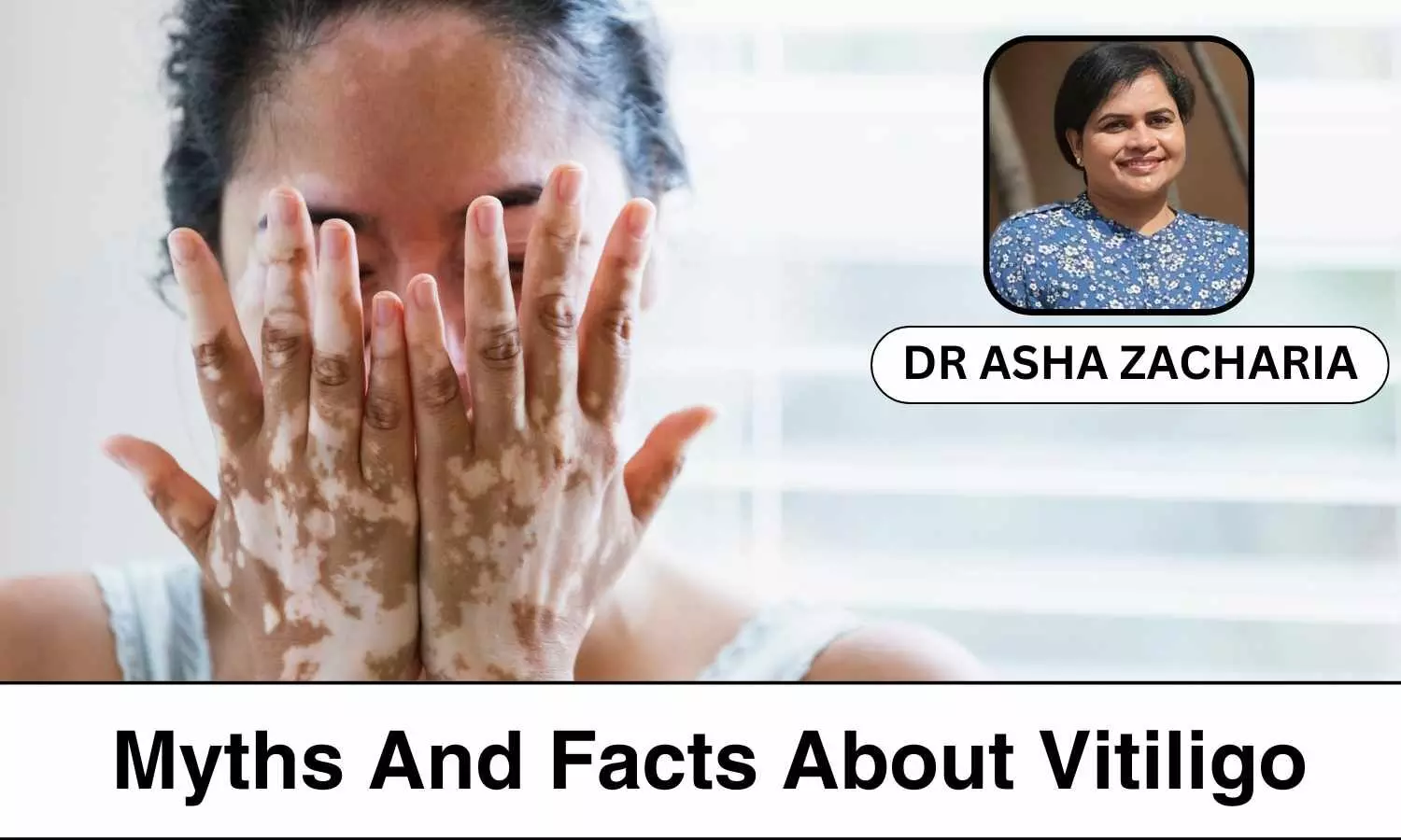 Understanding Vitiligo: Myths and Facts about Vitiligo - Dr Asha Zacharia