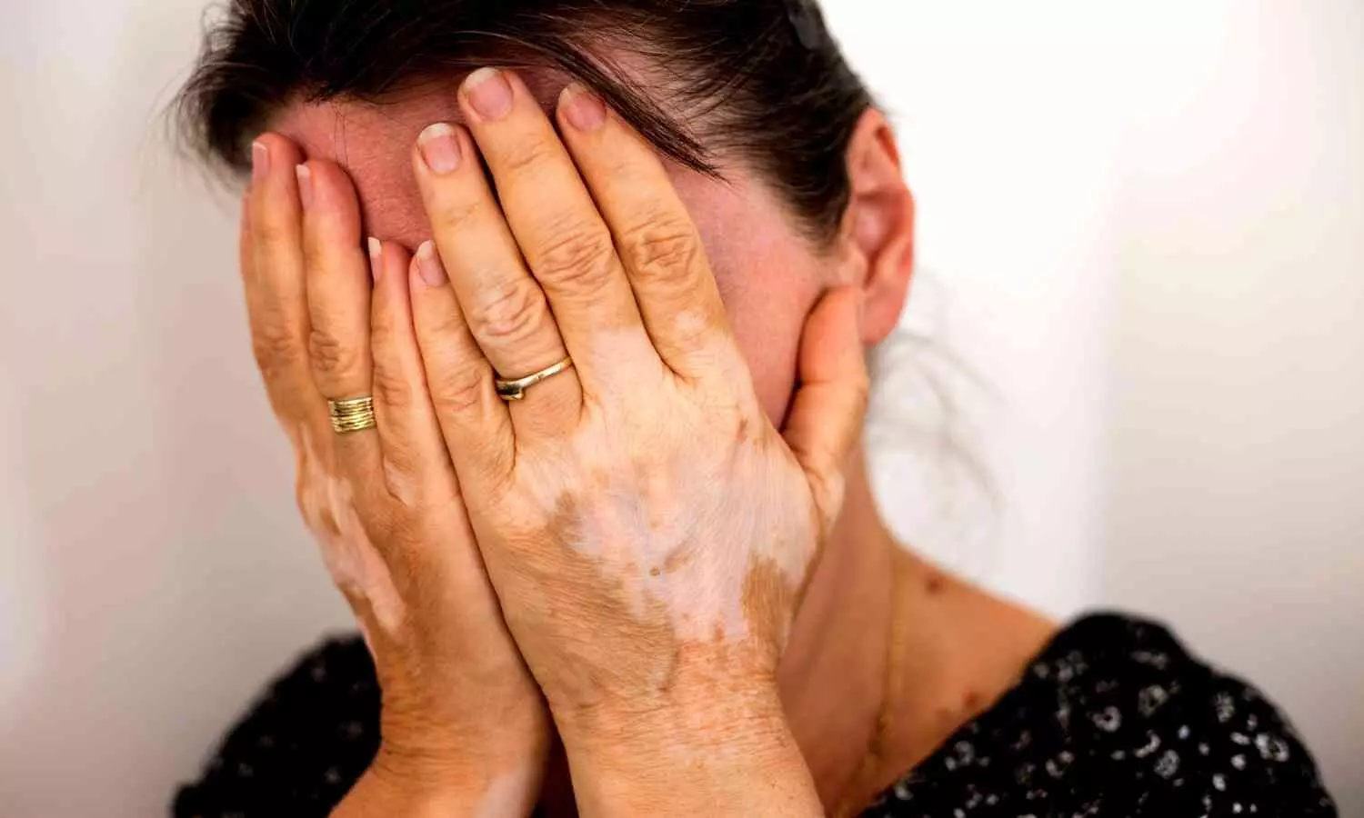 Doctors Identify Stigma as Major Cause of High Depression Rates in Vitiligo Patients