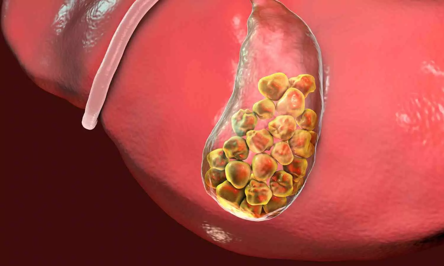 High Intake of Junk Food and Antacids Causes 1,500 Gallbladder Stones in Woman
