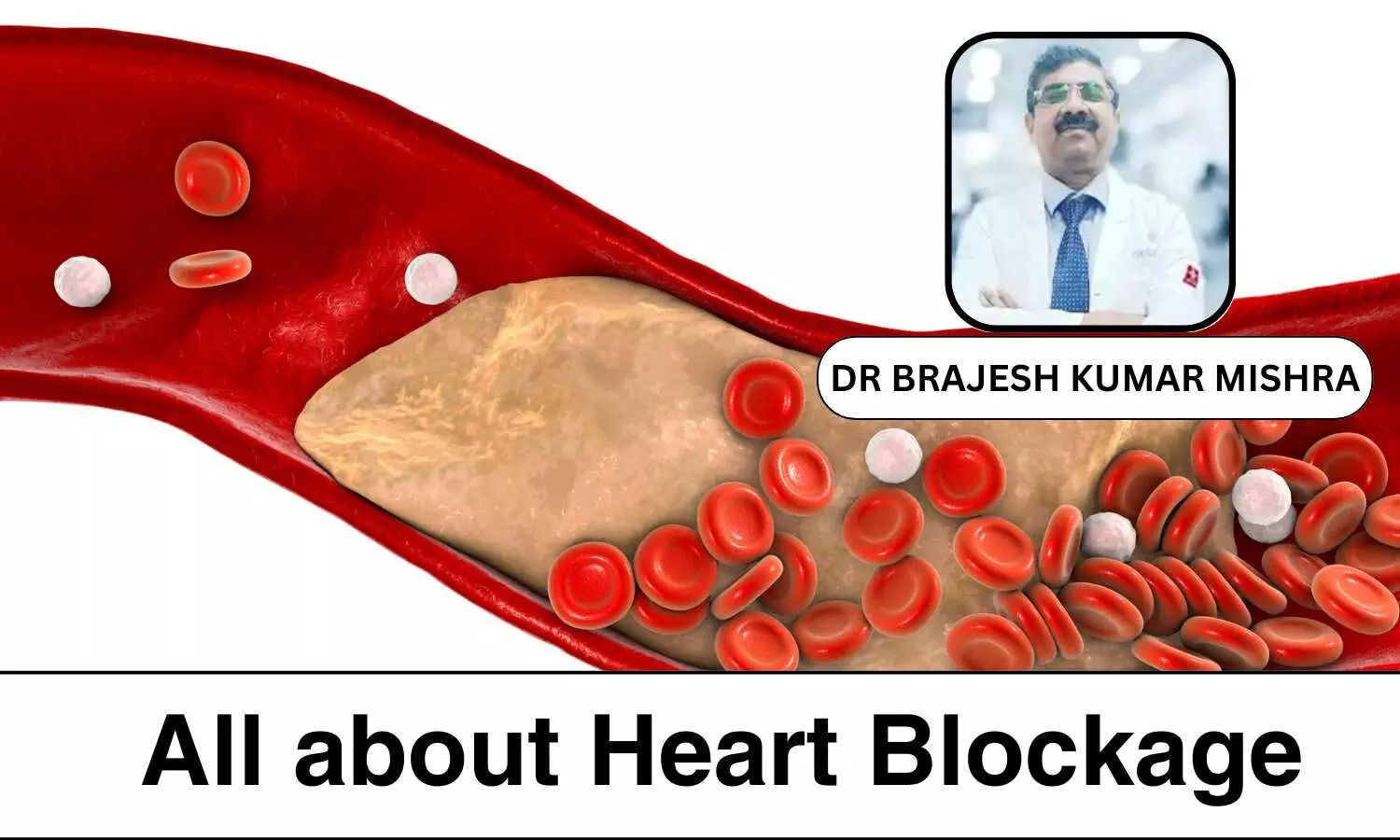 Understanding and Managing Heart Blockages: Causes, Diagnosis, and Treatment Options - Dr Brajesh Kumar Mishra