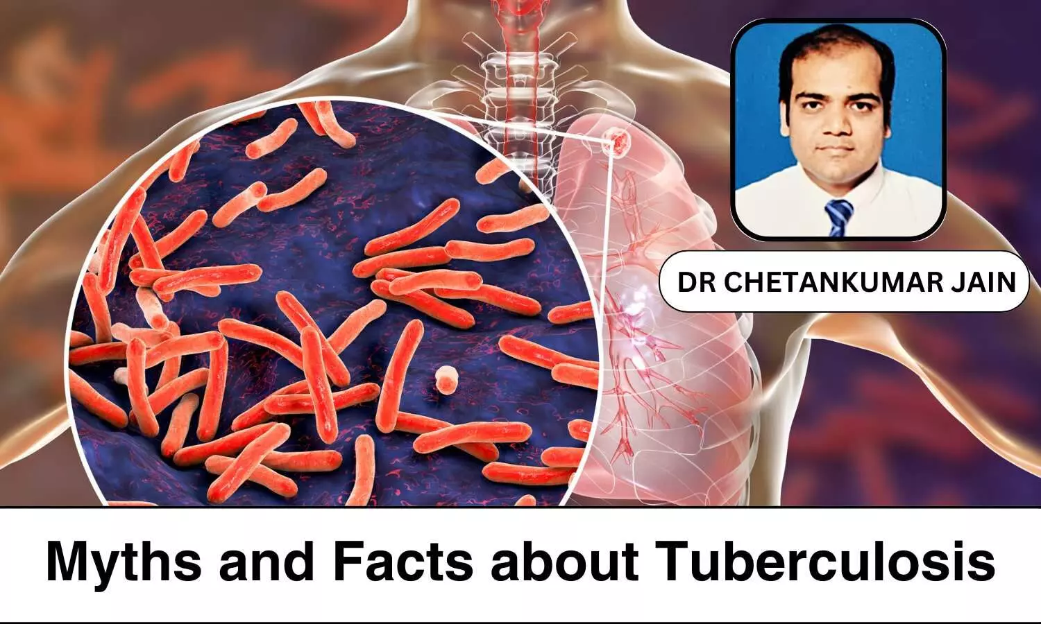 Common Myths About Tuberculosis And Facts That Dispel Them - Dr Chetankumar Jain