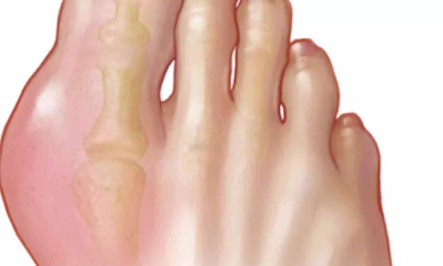 Study Predicts Over 70% Increase in Global Gout Prevalence by 2050