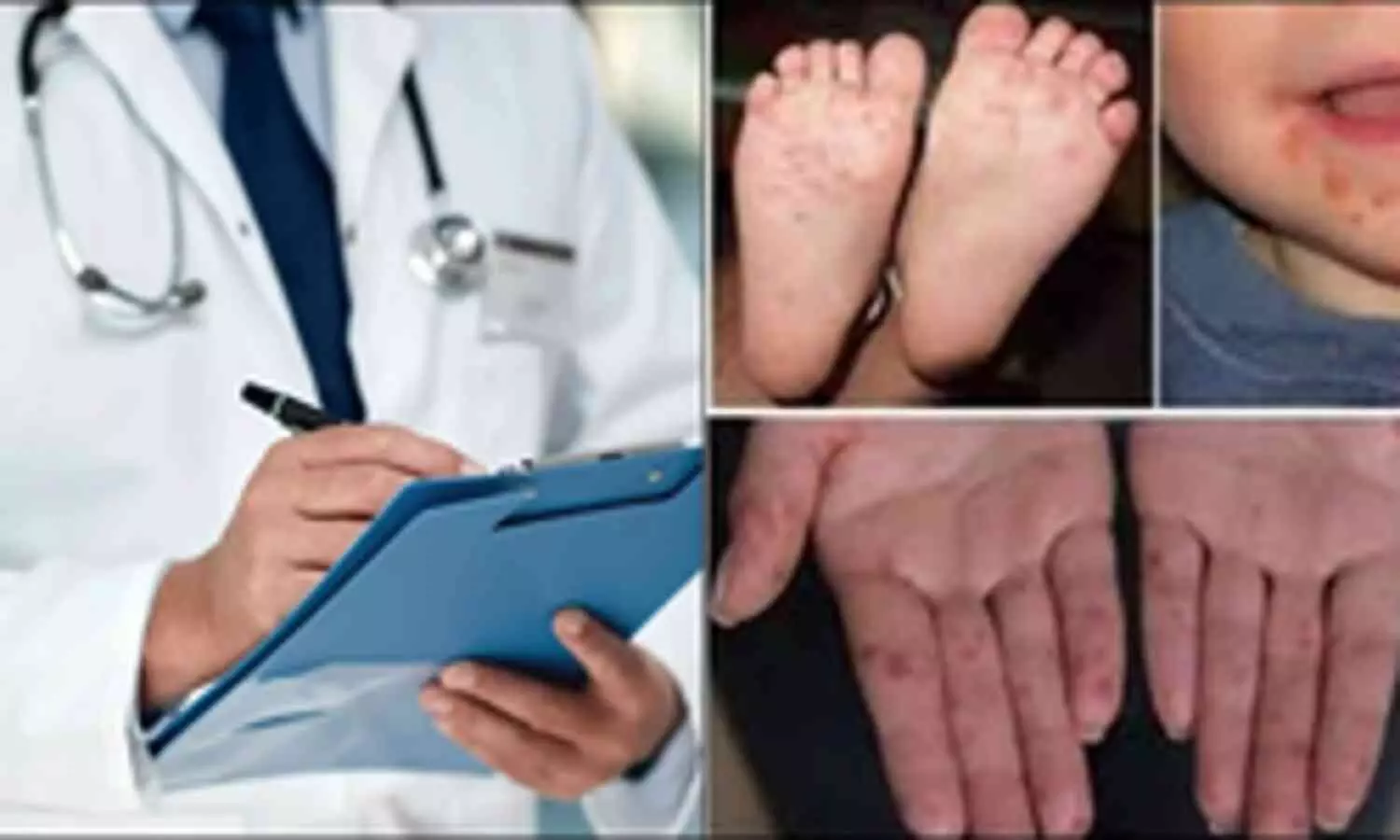 Surge in Hand, Foot & Mouth Disease Among Young Children, Say Doctors