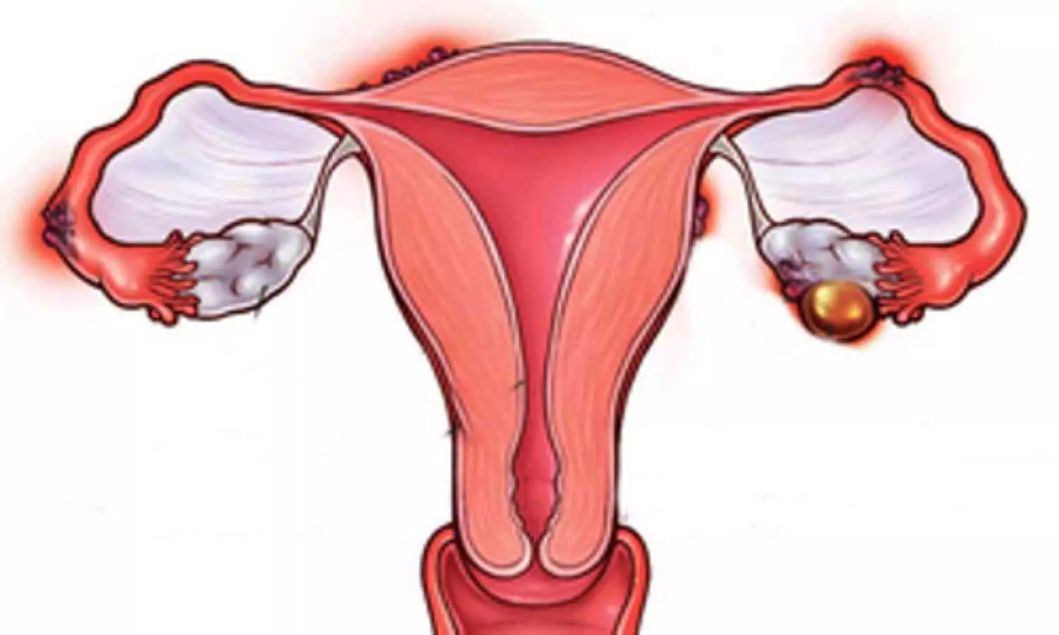 Doctors Raise Alarm About Recurring Uterine Fibroids in Young Women