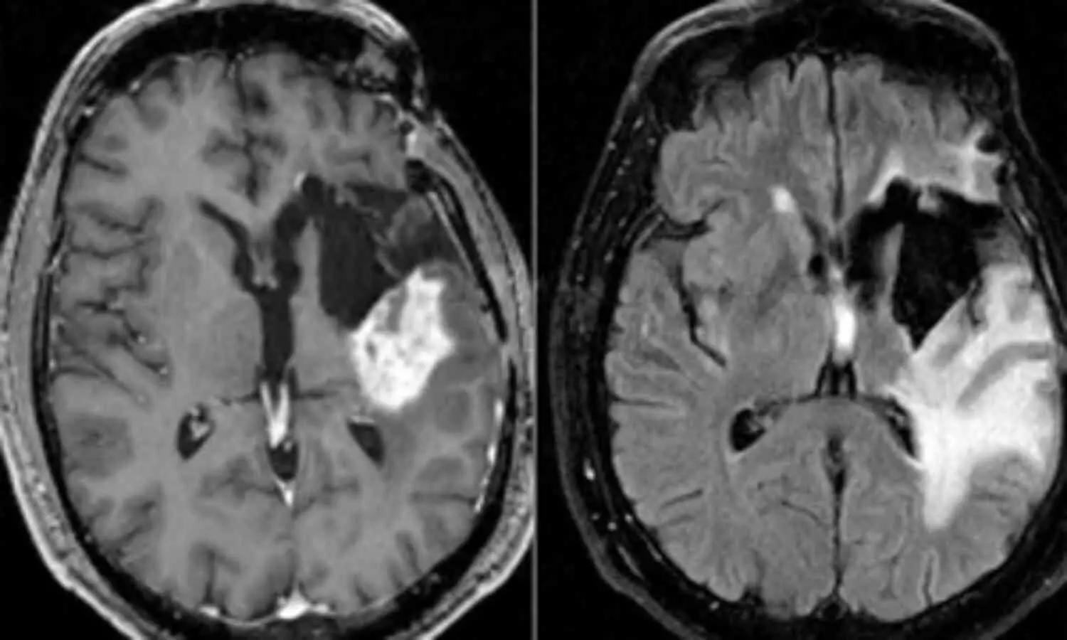 Discovery of Potent Immune Cells Near Glioblastomas Sparks Hope for Potential Cure