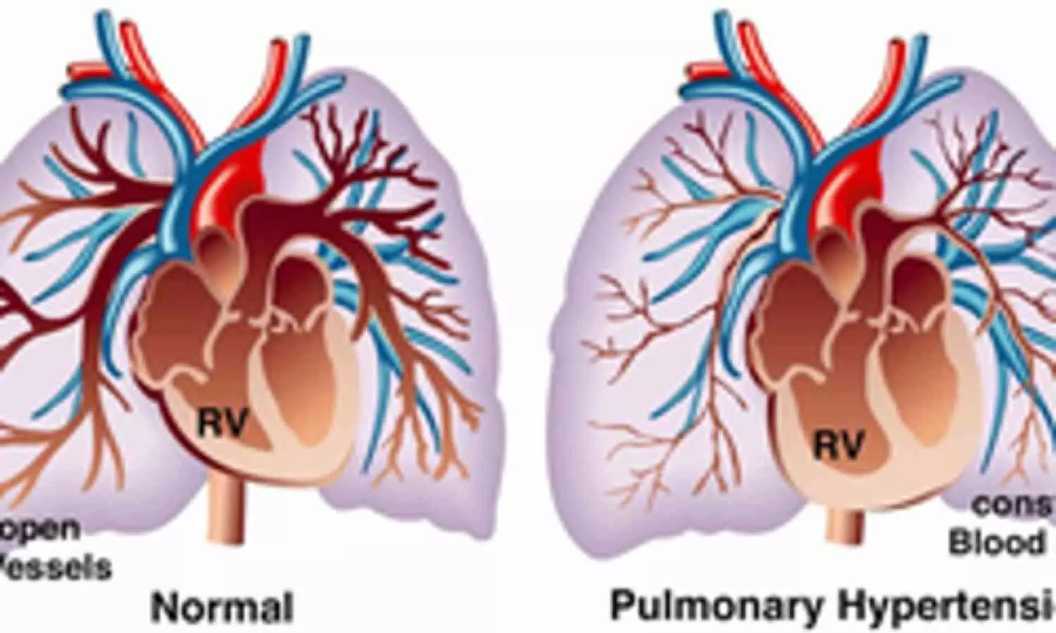 Indian Scientists Identify Four Overlooked Genes to Combat Deadly Lung Disease