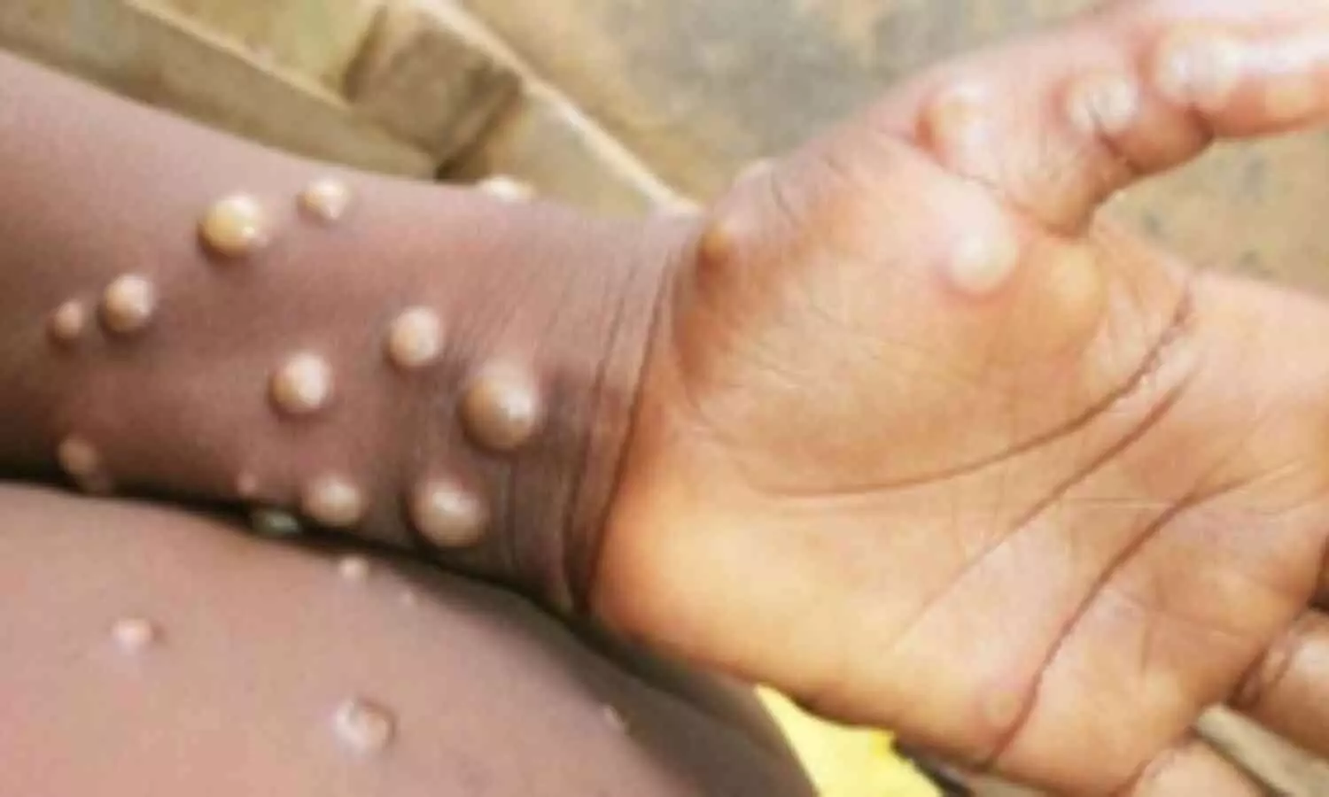 Africa CDC Urges Immediate Action Amid Alarming Spread of Mpox