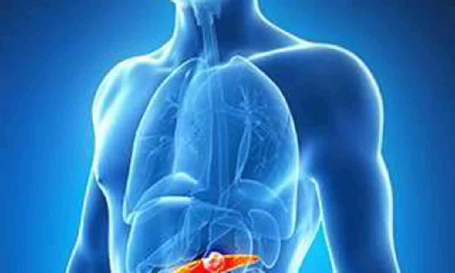 Ketogenic Diet Shows Potential Benefits for Pancreatic Cancer Patients