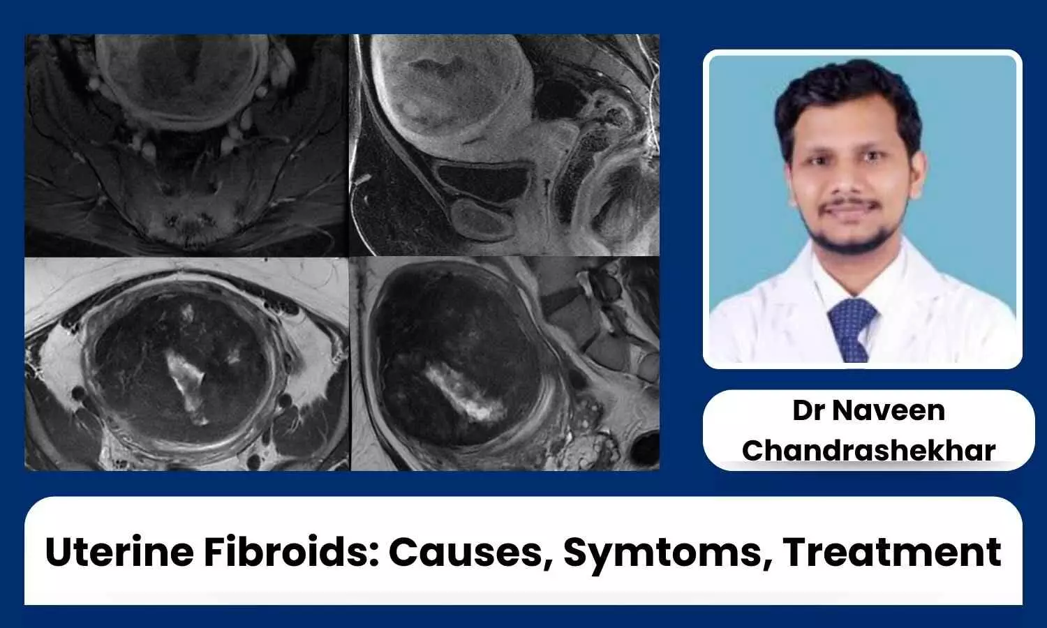 Uterine Fibroids: Insights into Causes, Symptoms, and Cutting-Edge Treatments - Dr Naveen Chandrashekhar