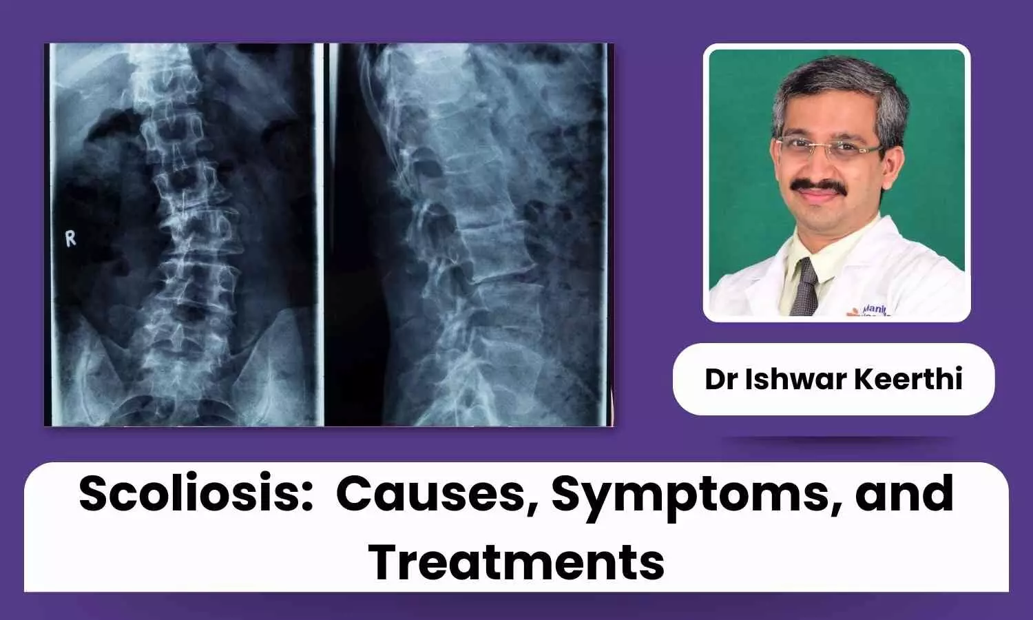 Scoliosis: A Comprehensive Overview of Causes, Symptoms, and Treatments - Dr Ishwar Keerthi