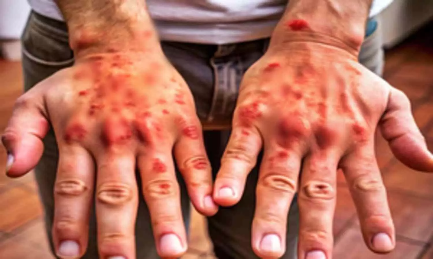 Experts say men are twice as likely to be affected by psoriasis