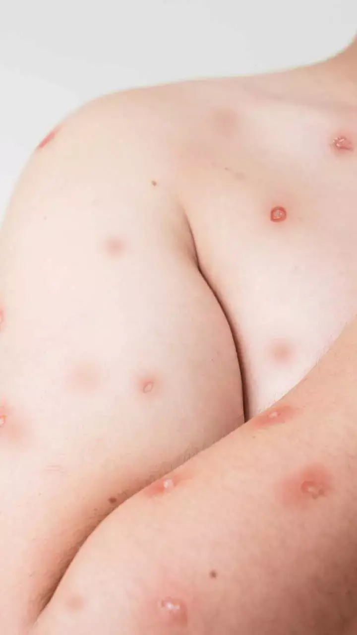MPOX First Case In India: Know All About MPOX