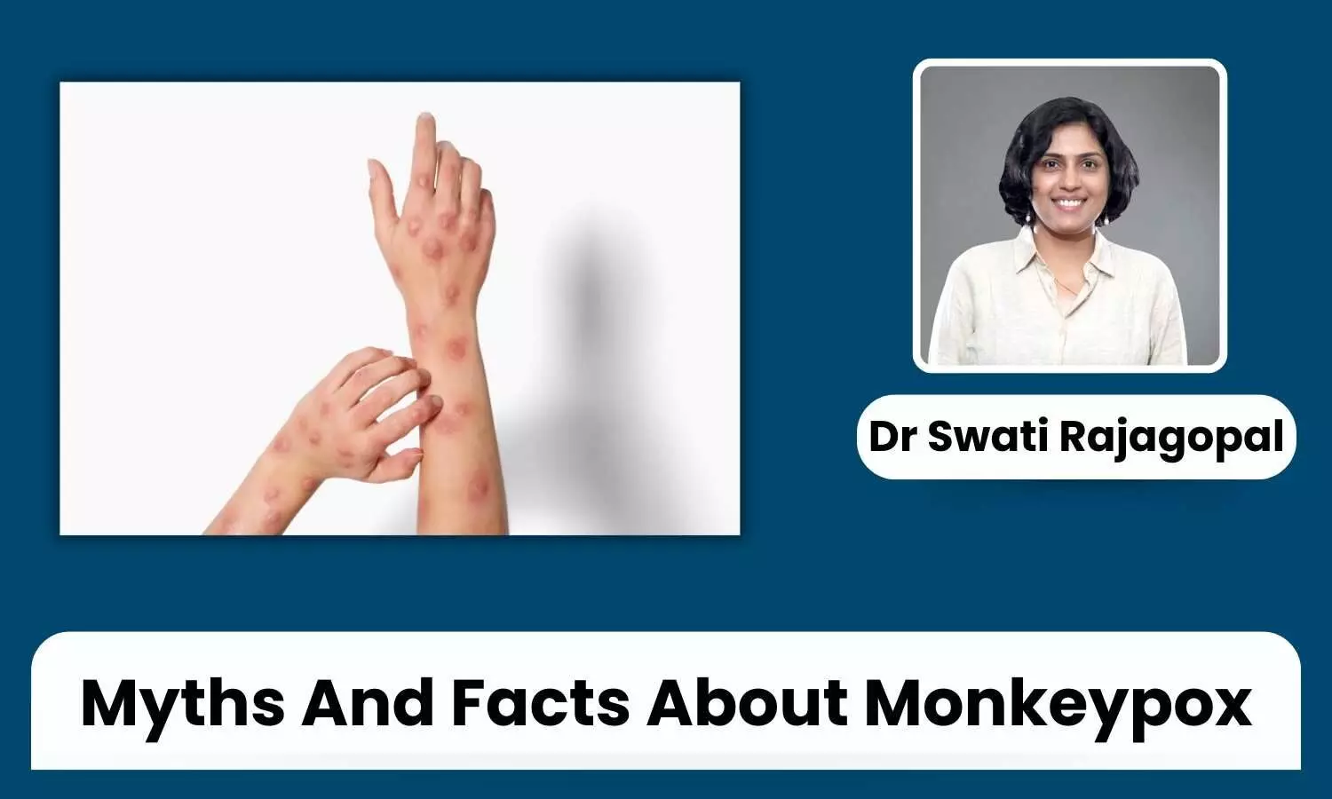 Debunking Common Myths About Monkeypox: Facts You Need to Know - Dr Swati Rajagopal