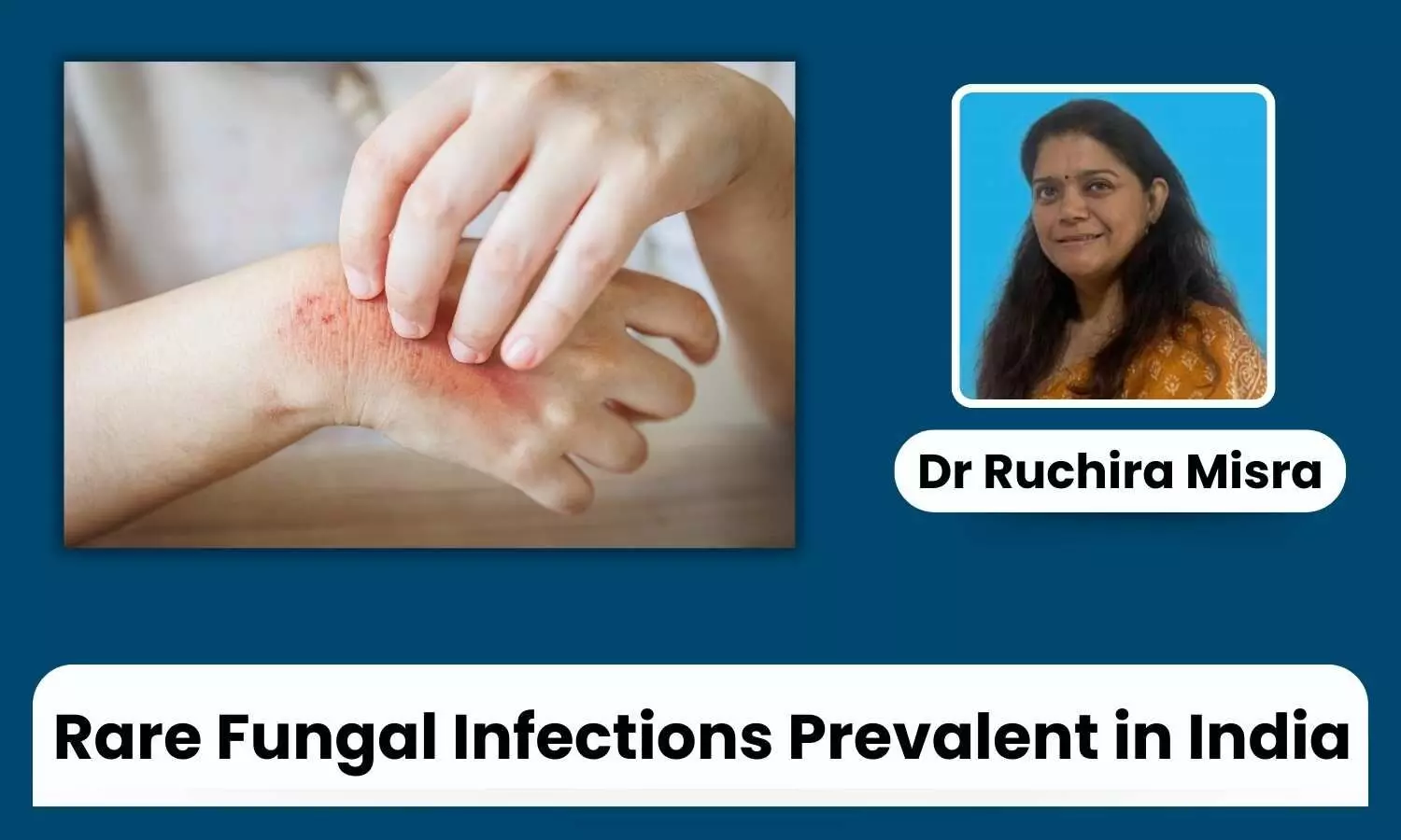 Rare Fungal Infections Prevalent in India: A Growing Health Challenge - Dr Ruchira Misra