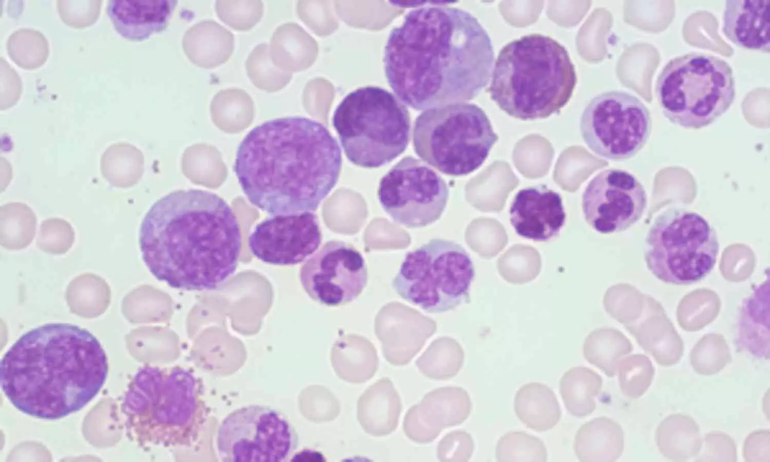 Targeted Therapies Boost Outcomes in Bone Marrow Cancer Treatment