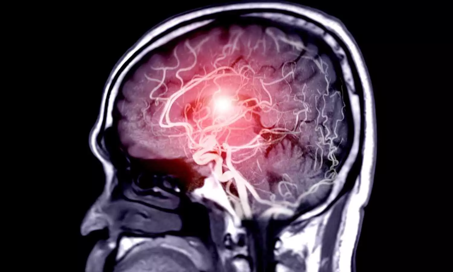 New Study Links Stroke to Immediate and Long-Term Cognitive Decline in Older Adults