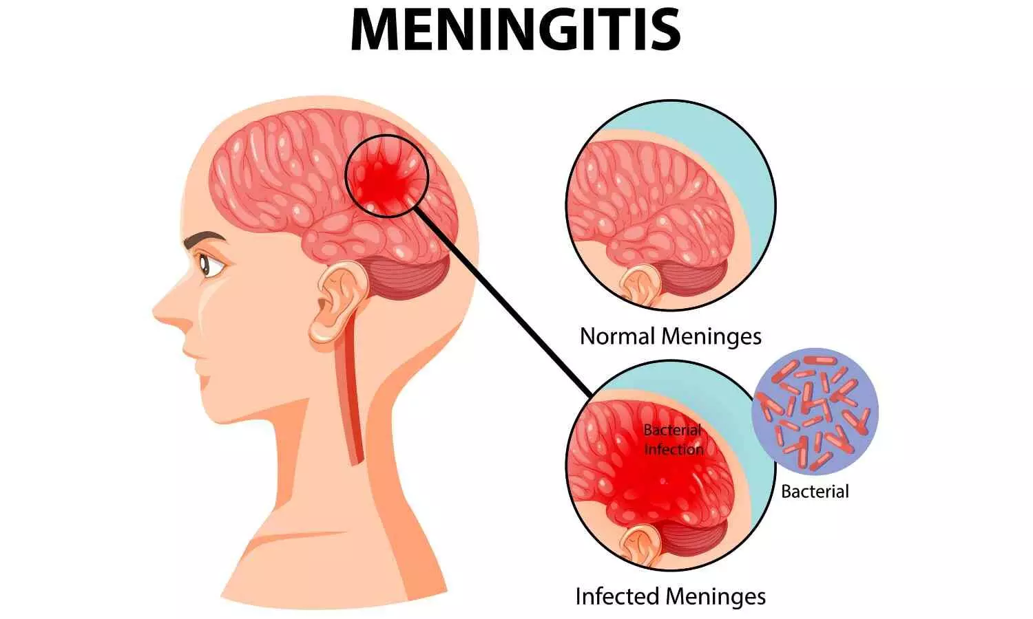 World Meningitis Day 2024: Experts Warn of Higher Risk in Children, Stress Importance of Vaccines