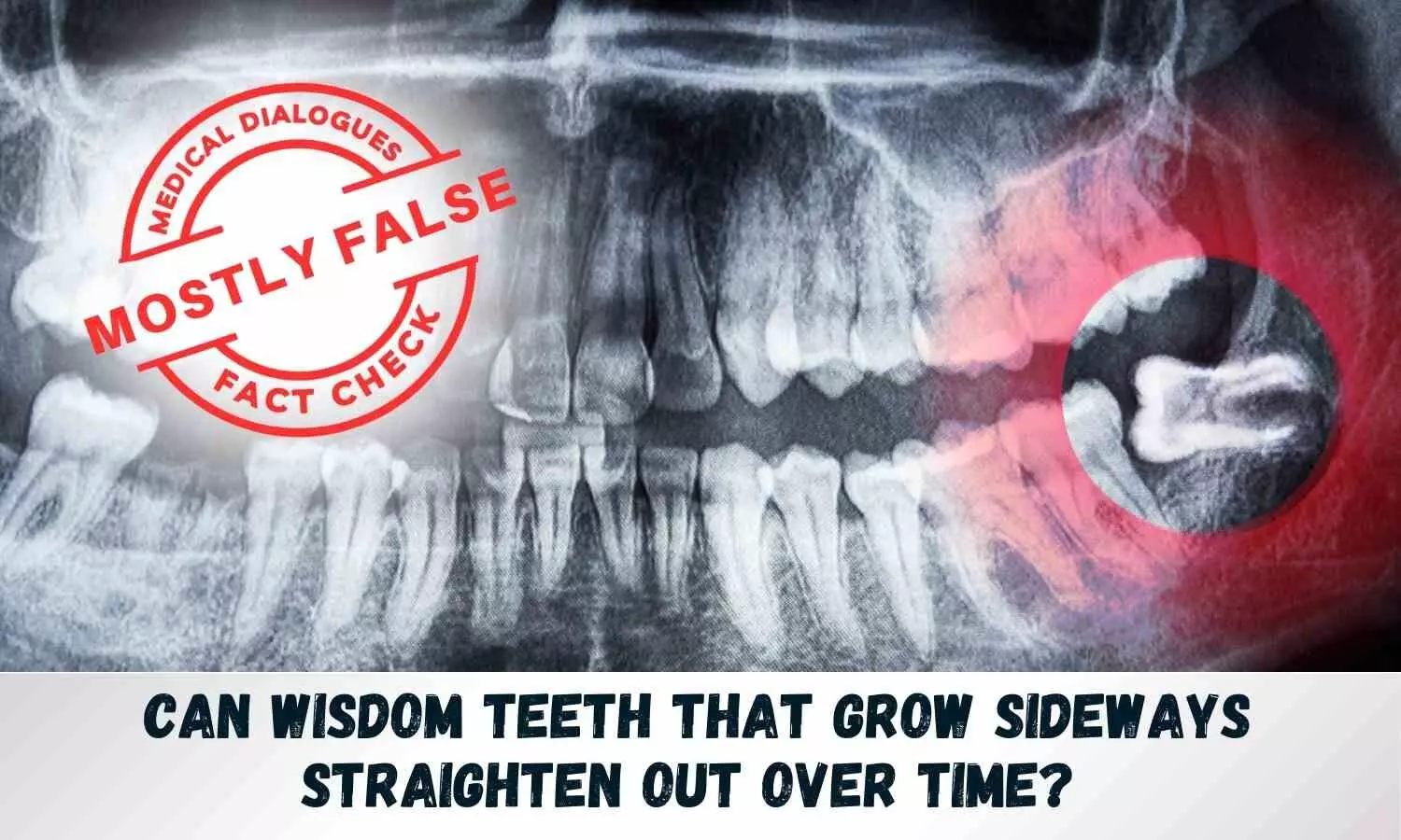 Fact Check: Can wisdom teeth that grow sideways straighten out over time?