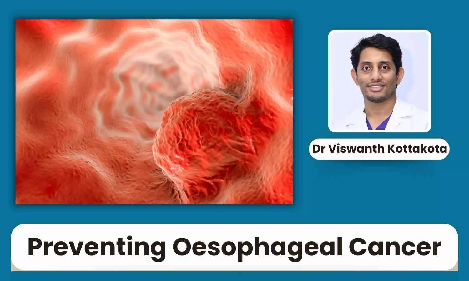 Preventing Oesophageal Cancer: Role of Lifestyle and Healthy Habits - Dr Viswanth Kottakota