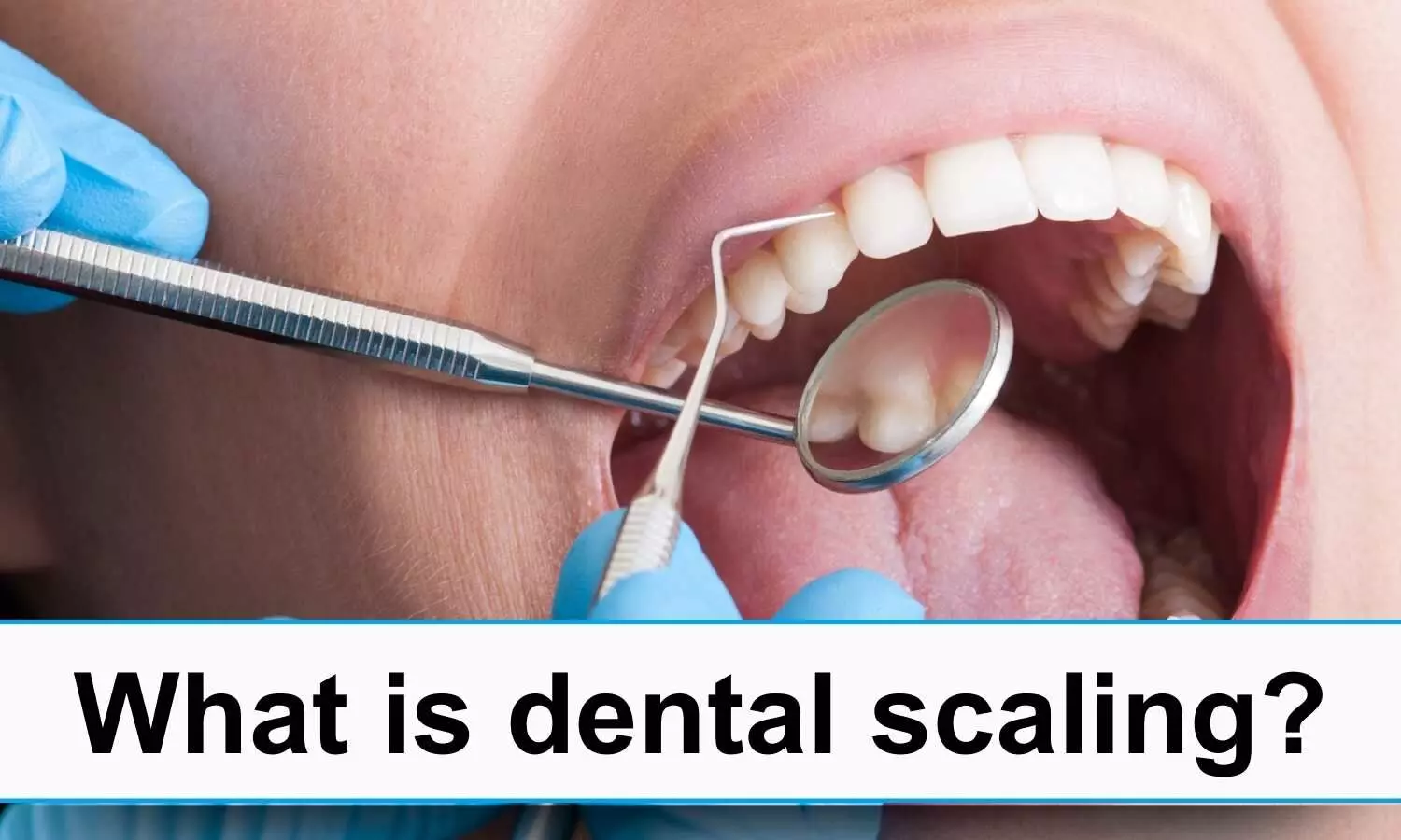 What is Dental Scaling?