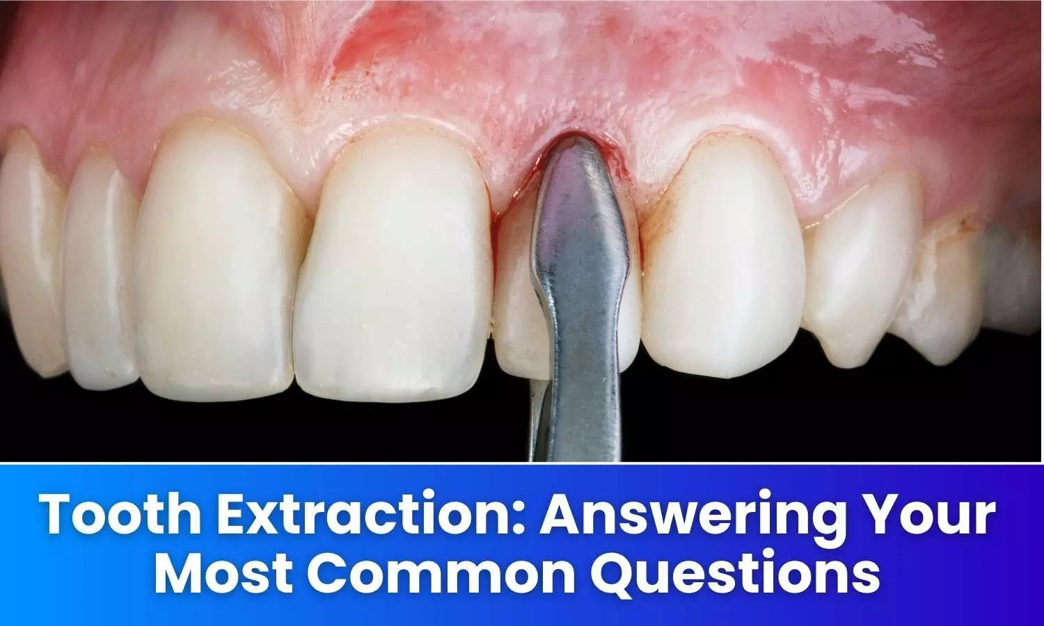 Tooth Extraction: Answering Your Most Common Questions