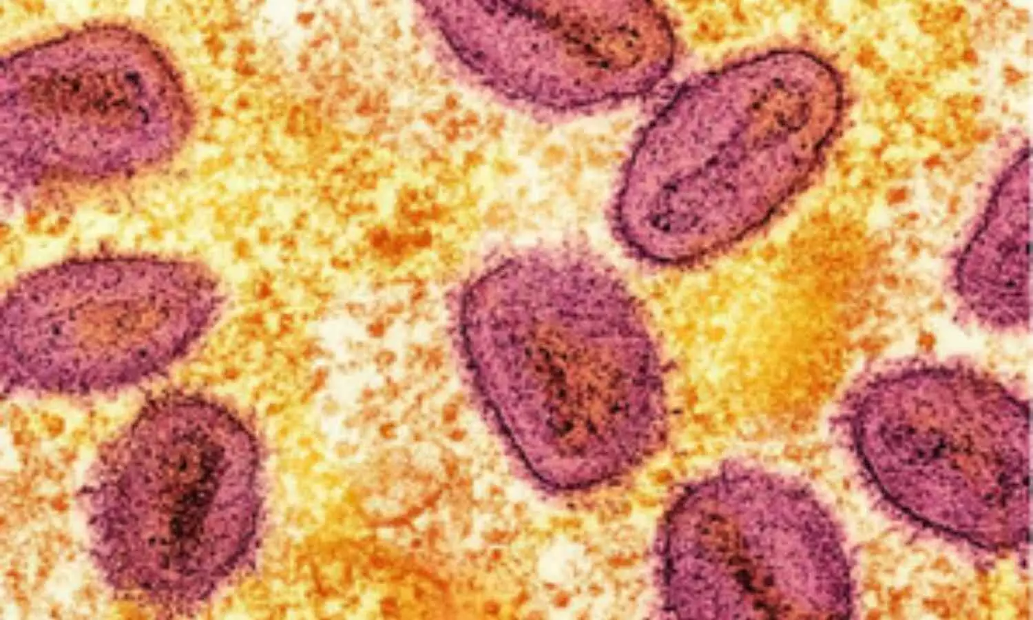 Zimbabwe Confirms Two Cases of Mpox