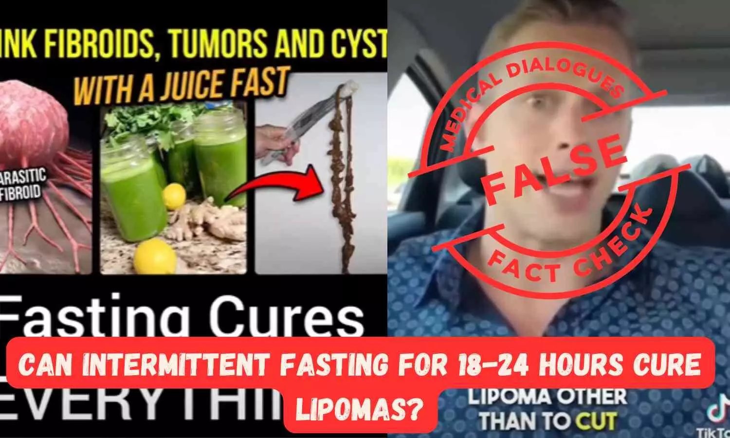 Fact Check: Can Intermittent fasting for 18-24 hours cure lipomas?