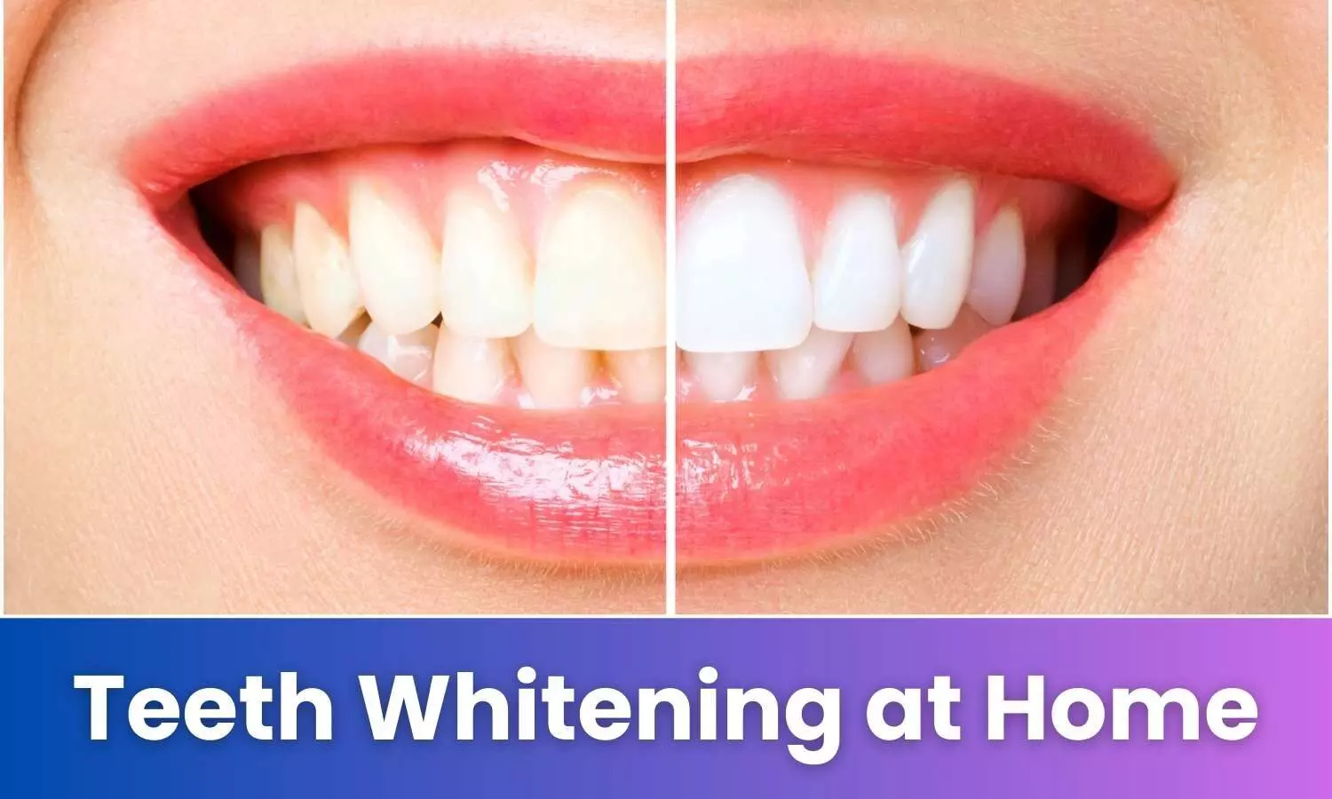 Teeth Whitening at Home