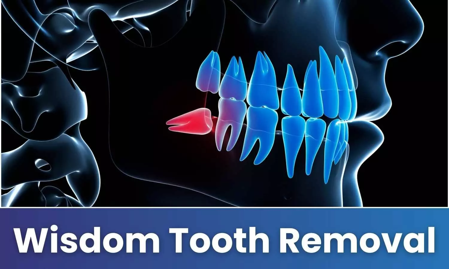 Wisdom Tooth Removal