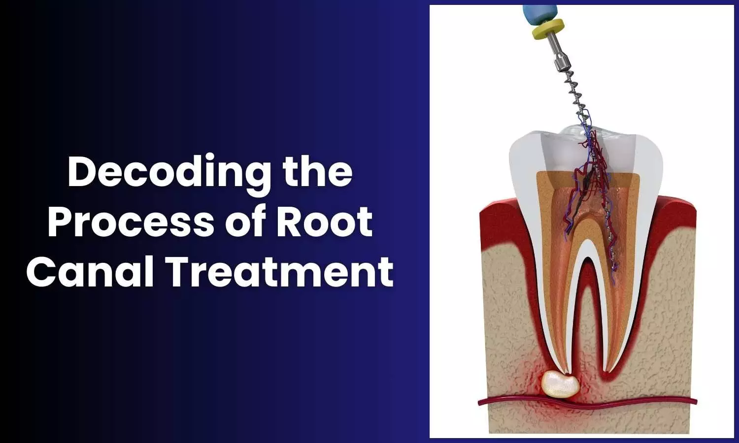 Decoding the process of Root Canal Treatment