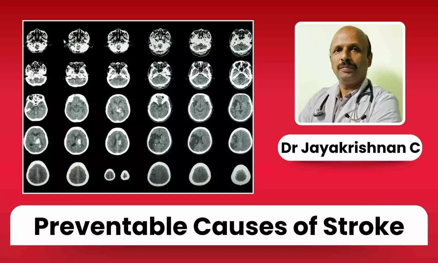 World Stroke Day 2024: Addressing the Top Preventable Causes of Stroke - Dr Jayakrishnan C