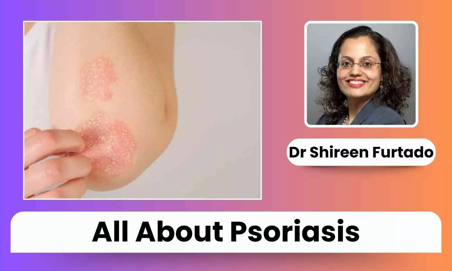 Psoriasis featured image