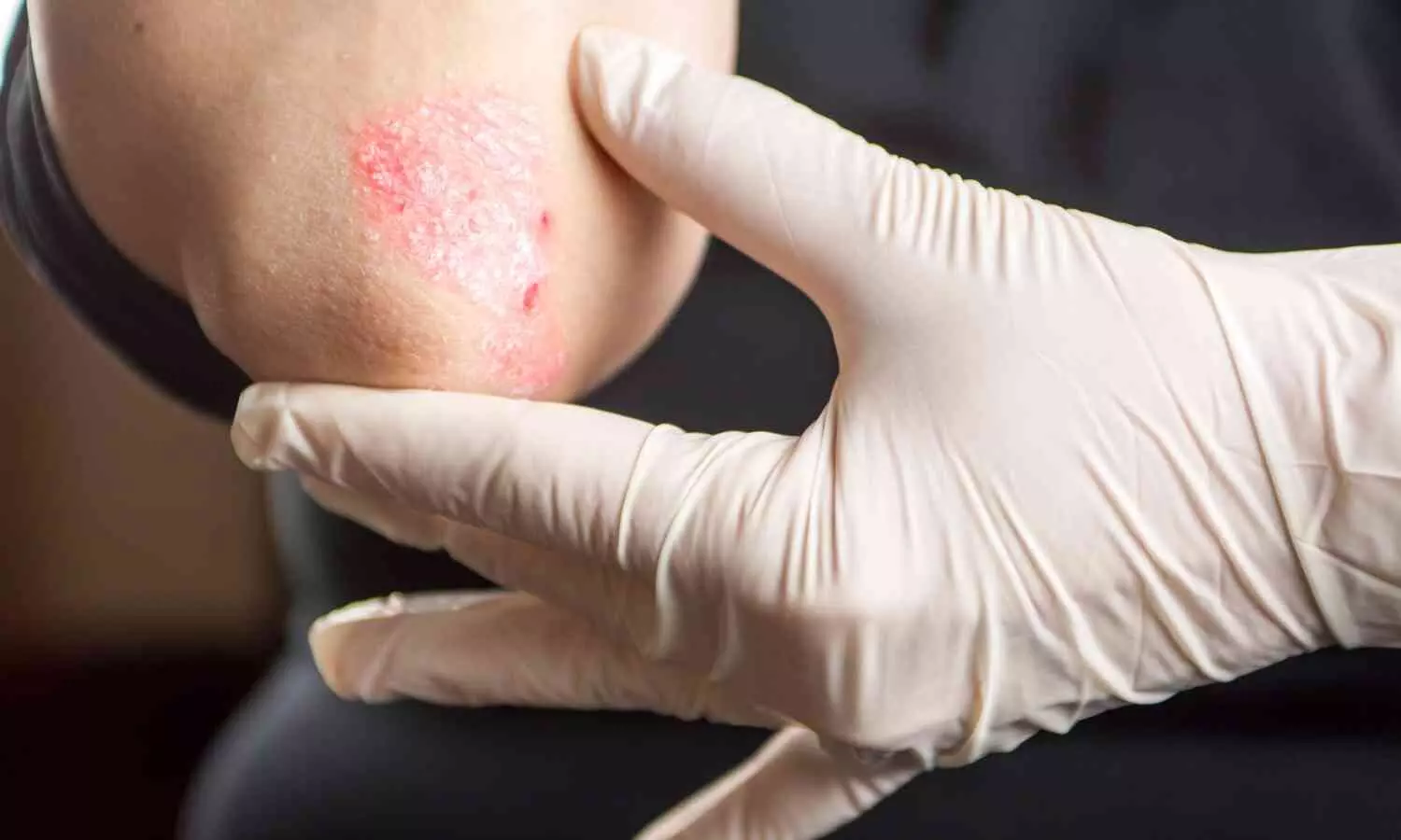 Experts Say 10-20% of Women Develop Psoriasis During Pregnancy