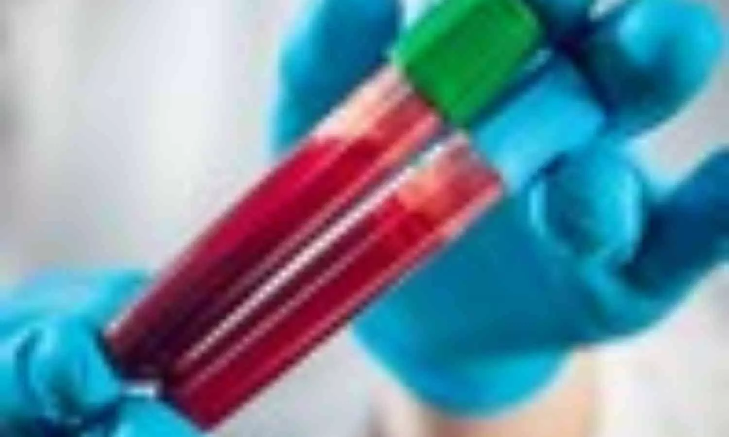 Blood Biomarker Tests Show Promise for Early Alzheimer’s Diagnosis: Report