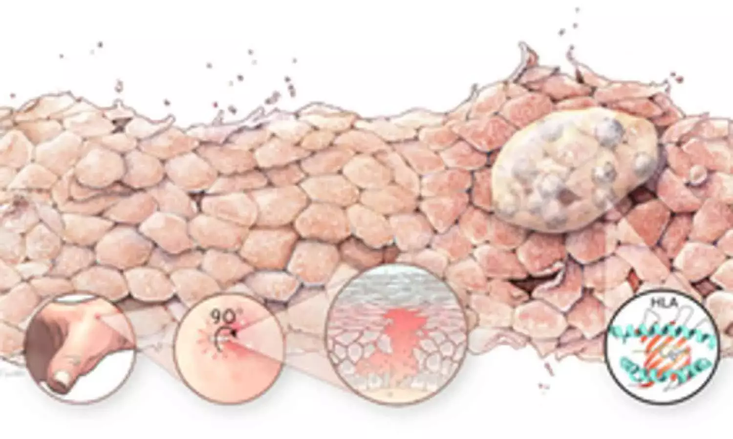 Australian-German Study Discovers Cure for Fatal Skin Disease