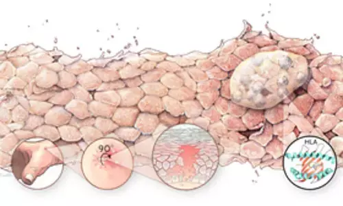 Australian-German Study Discovers Cure for Fatal Skin Disease Australian-German Study Discovers Cure for Fatal Skin Disease