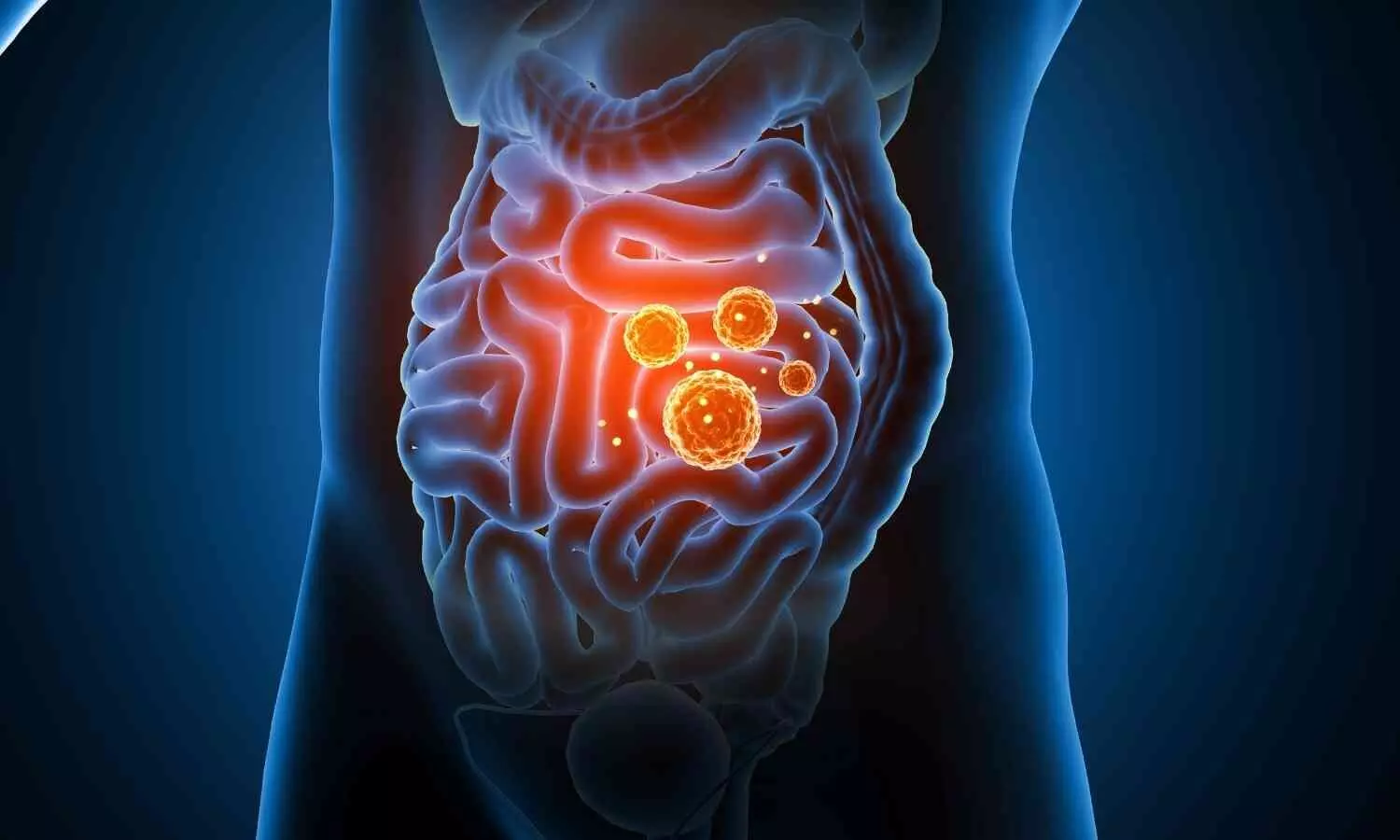 Image representing Gut Infection