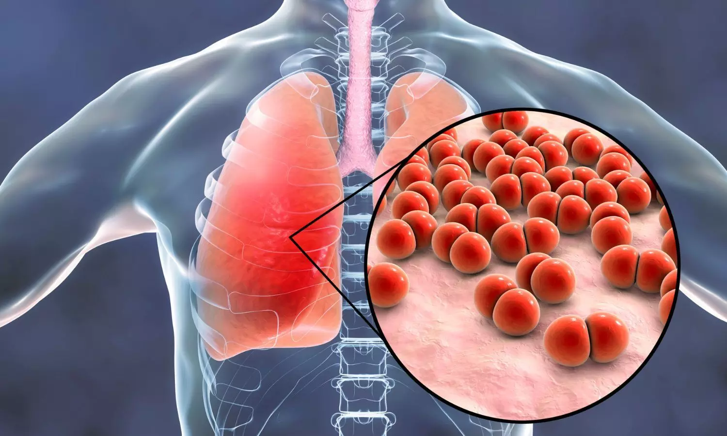 Image representing pneumonia bacteria