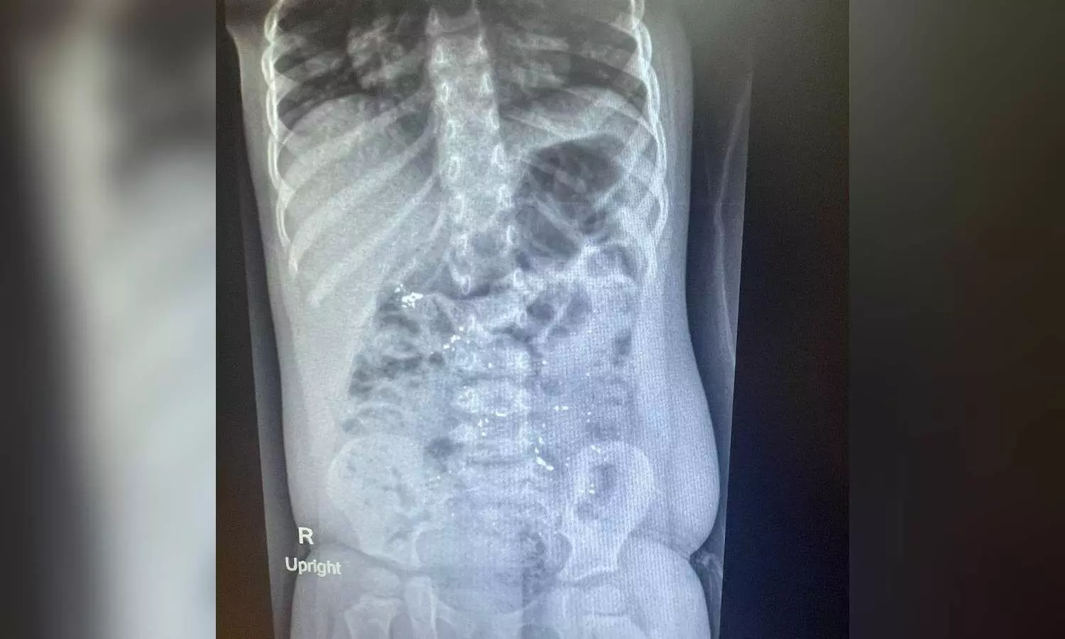 Xray image of the childs abdomen with mercury poisoning