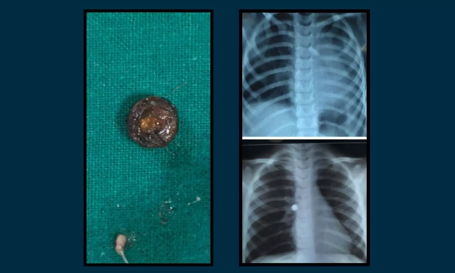 Image of the button battery removed and X-ray of the patients bronchus