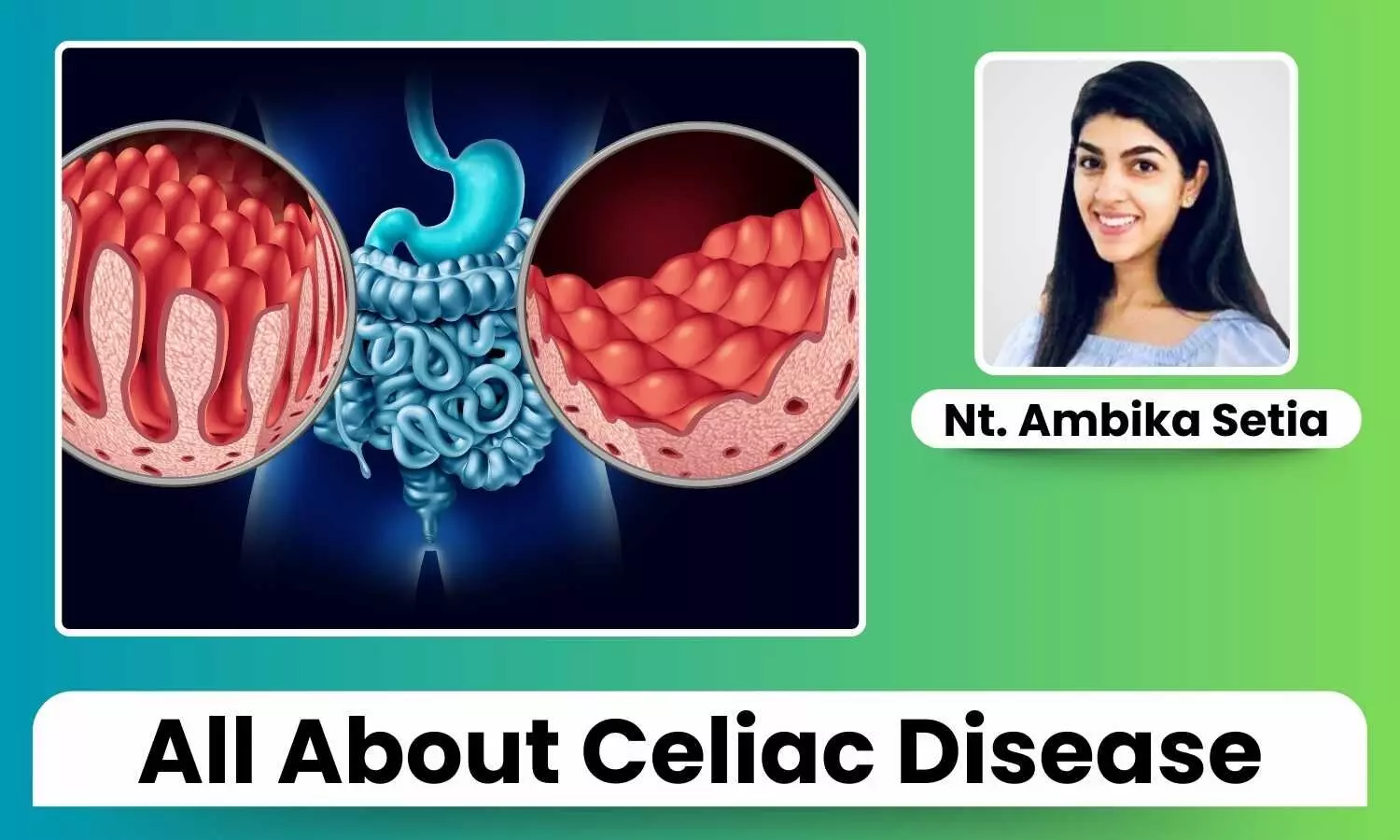 Featured image representing Celiac Disease