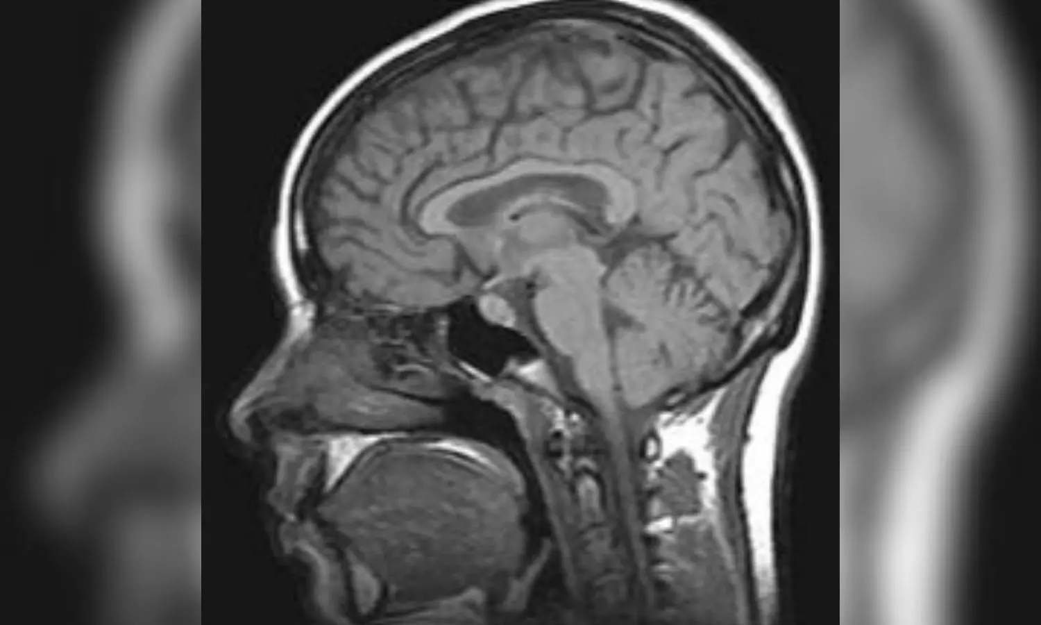 Image representing Idiopathic Intracranial Hypertension