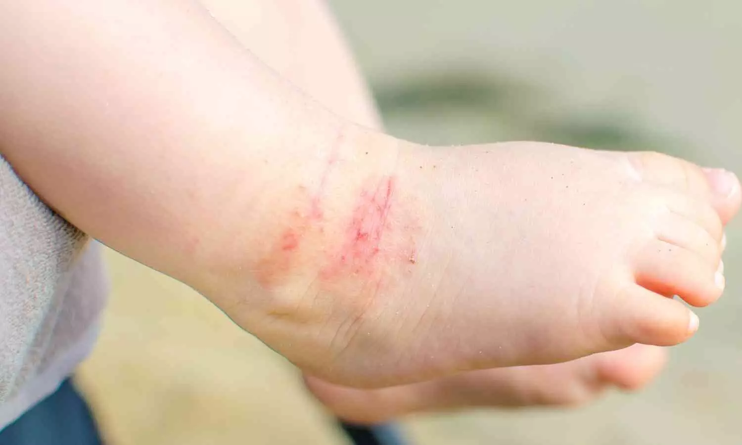 Image representing Atopic Dermatitis