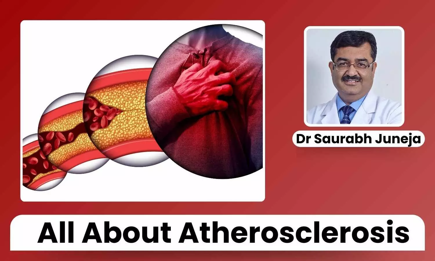 Featured image representing Atherosclerosis