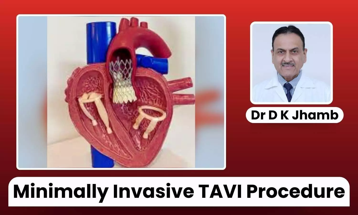 Featured image representing TAVI procedure